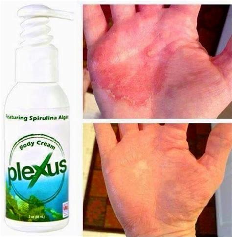 Help for eczema with Plexus Body Cream | Plexus products, Body cream ...