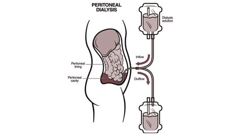 Easy and affordable access to Peritoneal Dialysis under PMNDP ...