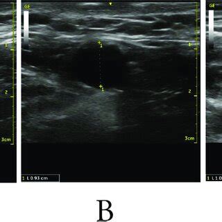 A-Ultrasound Image showing the subclavian vein diameter while the ...