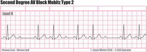 ECG Educator Blog : Second Degree AV Block Mobitz Type 2