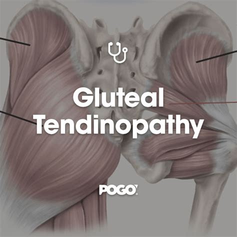 Gluteal Tendinopathy | POGO Physio Gold Coast