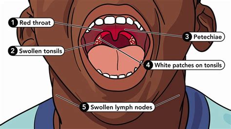 About Strep Throat | Group A Strep | CDC