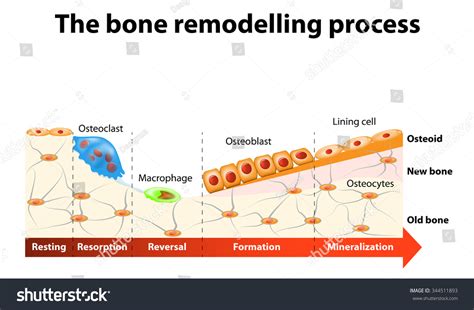 The Bone Remodeling Process Involves The Following Steps. In A Healthy ...