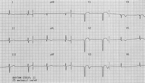 Left Ventricular Aneurysm • LITFL • ECG Library Diagnosis