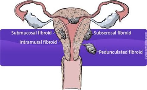 Robotic Myomectomy Surgery - Suburban Gynecology