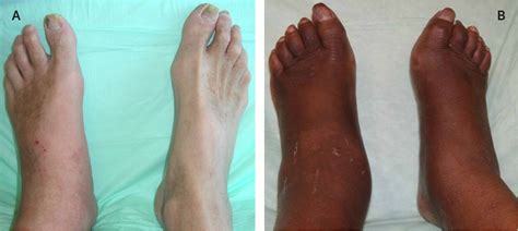 Charcot Foot: Clinical Clues, Diagnostic Strategies, and Treatment ...