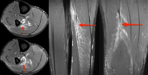 Case of the Week - Lateral Soleus Intramuscular Aponeurosis Tear ...