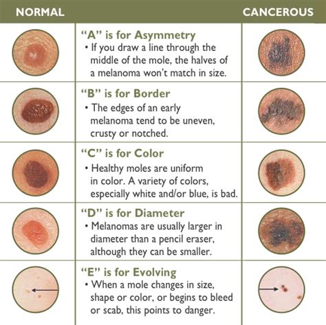 Healthy Viewpoints–Early signs of Skin Cancer