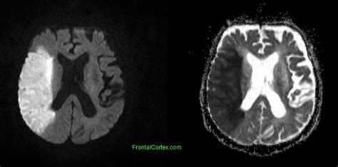 Image: MRI acute R MCA stroke