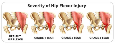 Hip Flexor Strain: Signs, Causes, Treatment and Recovery | IYTmed.com