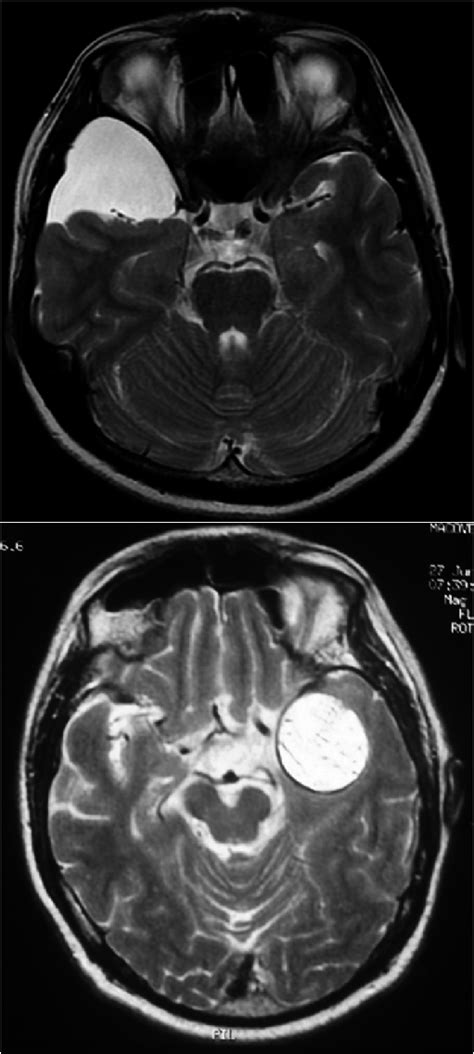 -differential diagnosis between an arachnoid cyst (a) and an epidermoid ...