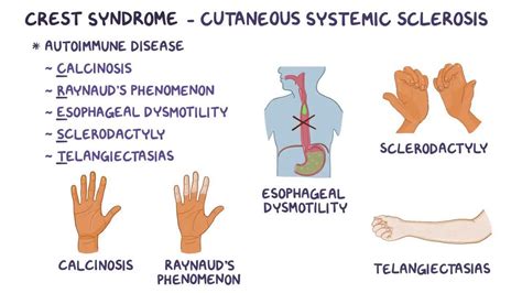 CREST syndrome - Osmosis