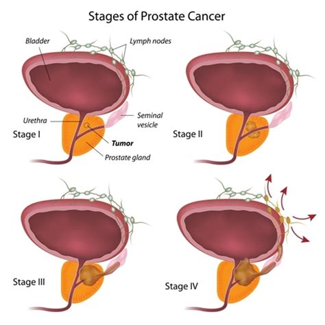 Prostate Cancer Stages