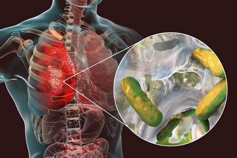 Lung Model On a Chip Better Identifies CF-Related Bacterial Infections ...