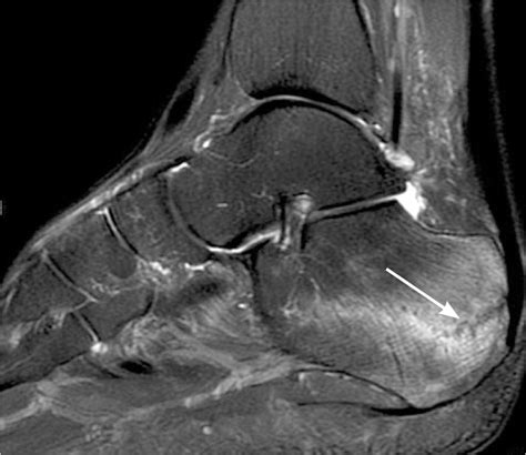 Diagnosis of Heel Pain | AAFP