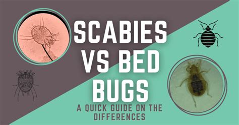 Bed Bug Vs Scabies Rashes Know The Differences – NBKomputer