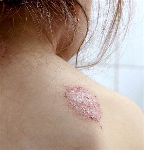 What Triggers Eczema Flare-ups? Tips to Prevent Eczema Outbreaks