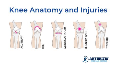 Knee Pain Location Chart - Arthritis Knee Pain Centers