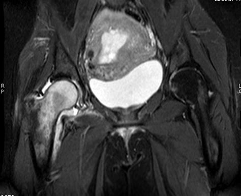 Transient bone marrow oedema of the hip-MRI - Sumer's Radiology Blog