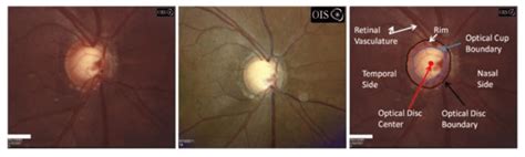 A glaucomatous patient with progressed optic nerve cupping as shown by ...