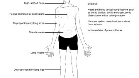 Marfan syndrome: genetics, symptoms, diagnosis and treatment - Online ...