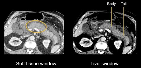 Abdominal CT: necrotizing pancreatitis • LITFL • Radiology Library