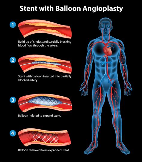 Treating Stable Angina with Angioplasty & Stenting