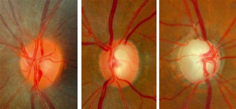 What is Glaucoma - What Causes Glaucoma (Simple Answer) - Eye CU ...