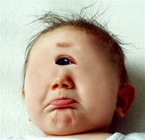 The One Eyed Syndrome | Birth defects, A child is born, Birth