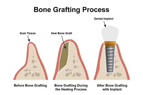 Candidate for a Dental Bone Grafting - Lincoln, NE