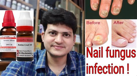 fungal nail infection in children treatment 5 home remedies for ...