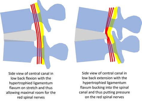 Ligamentum Flavum Hypertrophy Mri