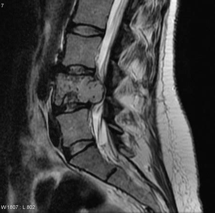 Chondrosarcoma Mri