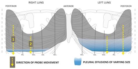 Lung ultrasound: Pleural effusion • LITFL • Ultrasound library