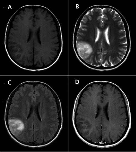 Brain Mri Scan Tumor