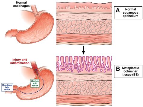 Barretts Esophagus Histology