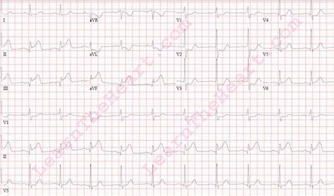 Inferior-Posterior Wall MI ECG (Example 1) | Learn the Heart