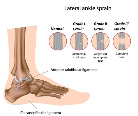 Sprained Ankle - Definition, Anatomy and Causes (Video) - Jeffrey H ...