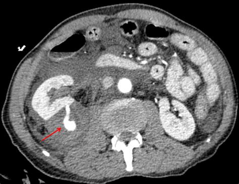 Retroperitoneal Hematoma Management