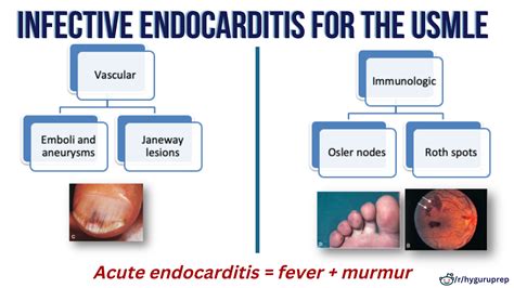 Image Infective Endocarditis Janeway Lesions Merck