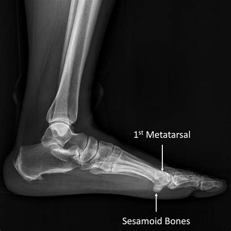 Sesamoid Bone Fracture