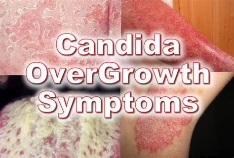 Candida Rash On Hands