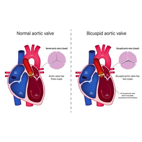 8 Common Symptoms For Aortic Valve Regurgitation | Vejthani