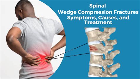 Wedge In Spine