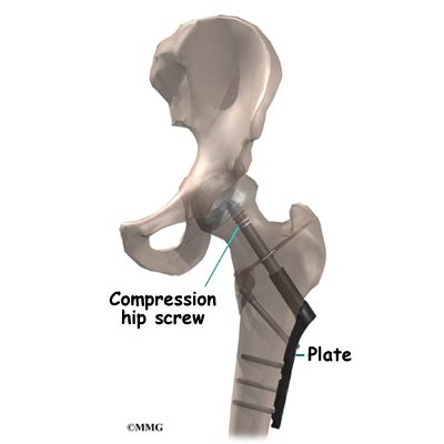 Compression Fixation for a Fractured Hip - Orthopedic Surgery ...