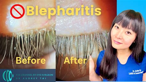 Best Blepharitis Treatments at Home | Simple & Effective | Step by Step ...