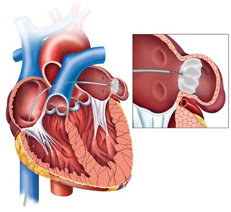 Left Atrial Appendage Closure For Atrial Fibrillation Patients ...