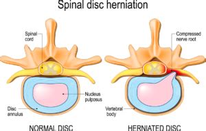 Herniated Disc Treatment and Symptoms | AllSpine