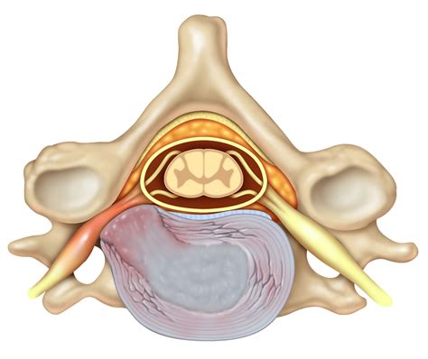 Pinched Nerve in Neck: Causes, Symptoms, and Treatments