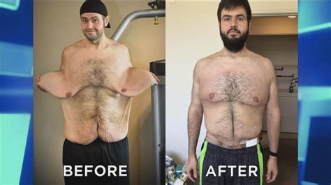 Man Who Lost over 300 Pounds Returns after Skin Removal Surgery - YouTube